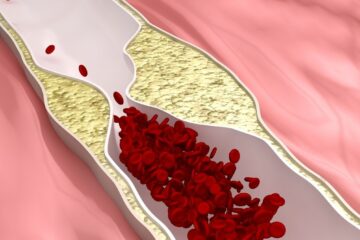 Ateroskleroz (Damar Sertliği) Nedir?