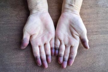 Buerger Hastalığı Nedir?